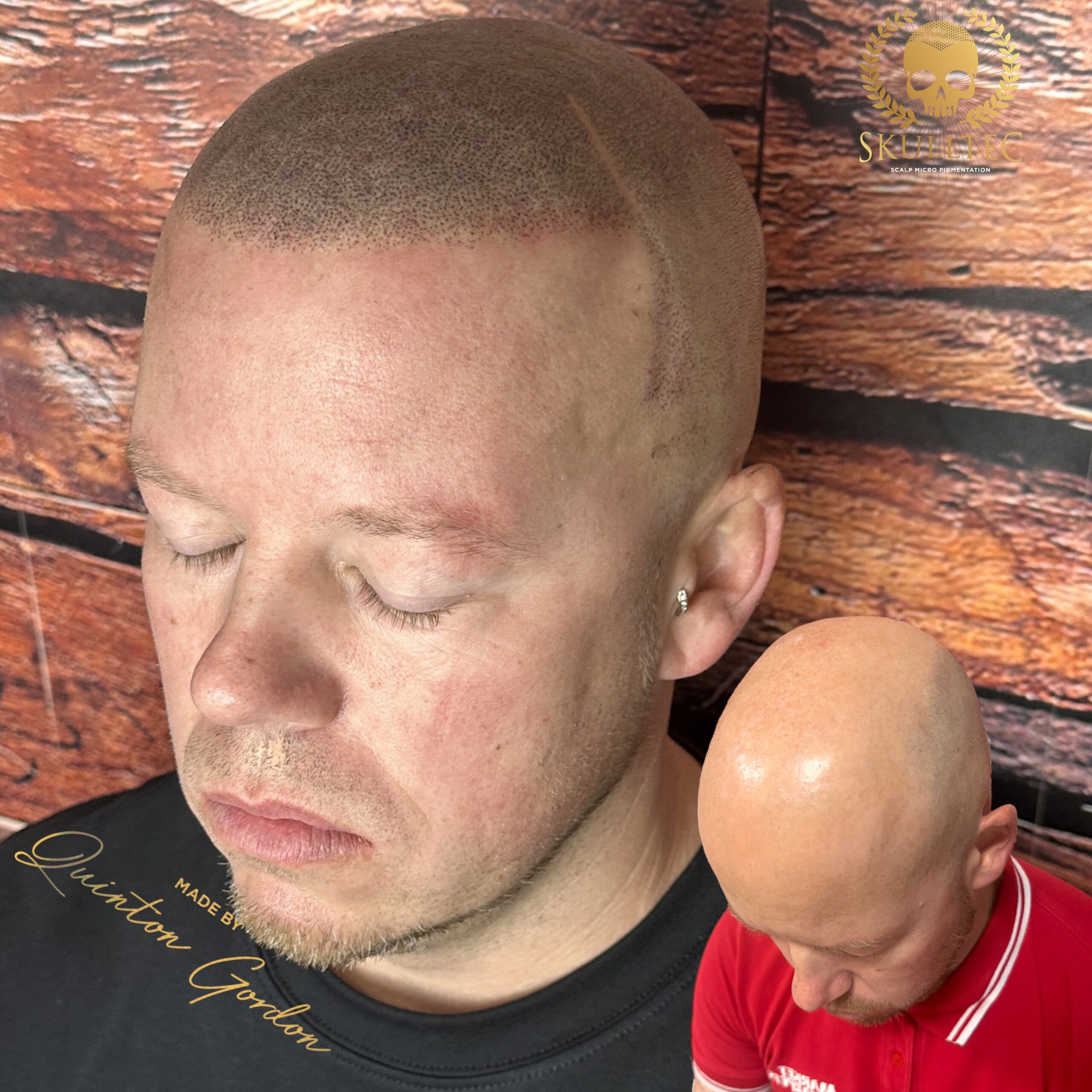 Skulltec - Hairloss 47011a9e 9fda 4240 93c0 673d82b9024f