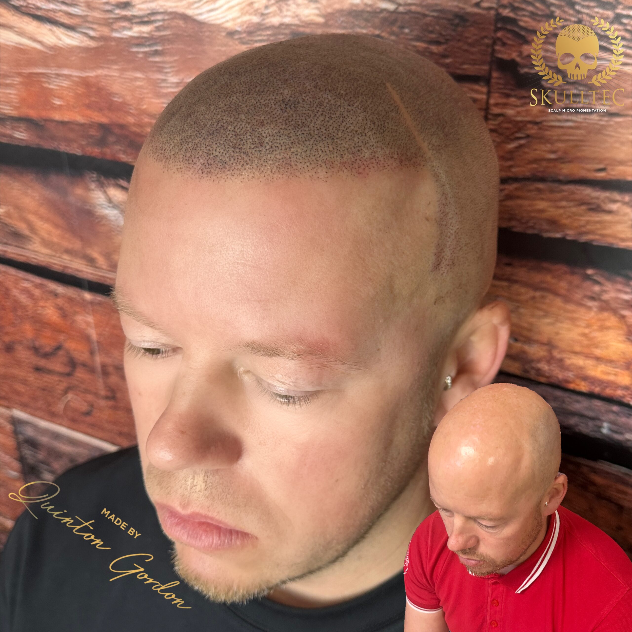 Skulltec - Hairloss 69804ec7 27c1 45bf a4ea a641f2ba8b3f