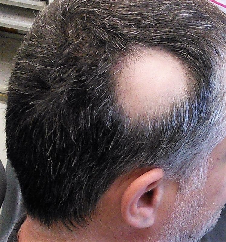 alopecia areata 1 748x800