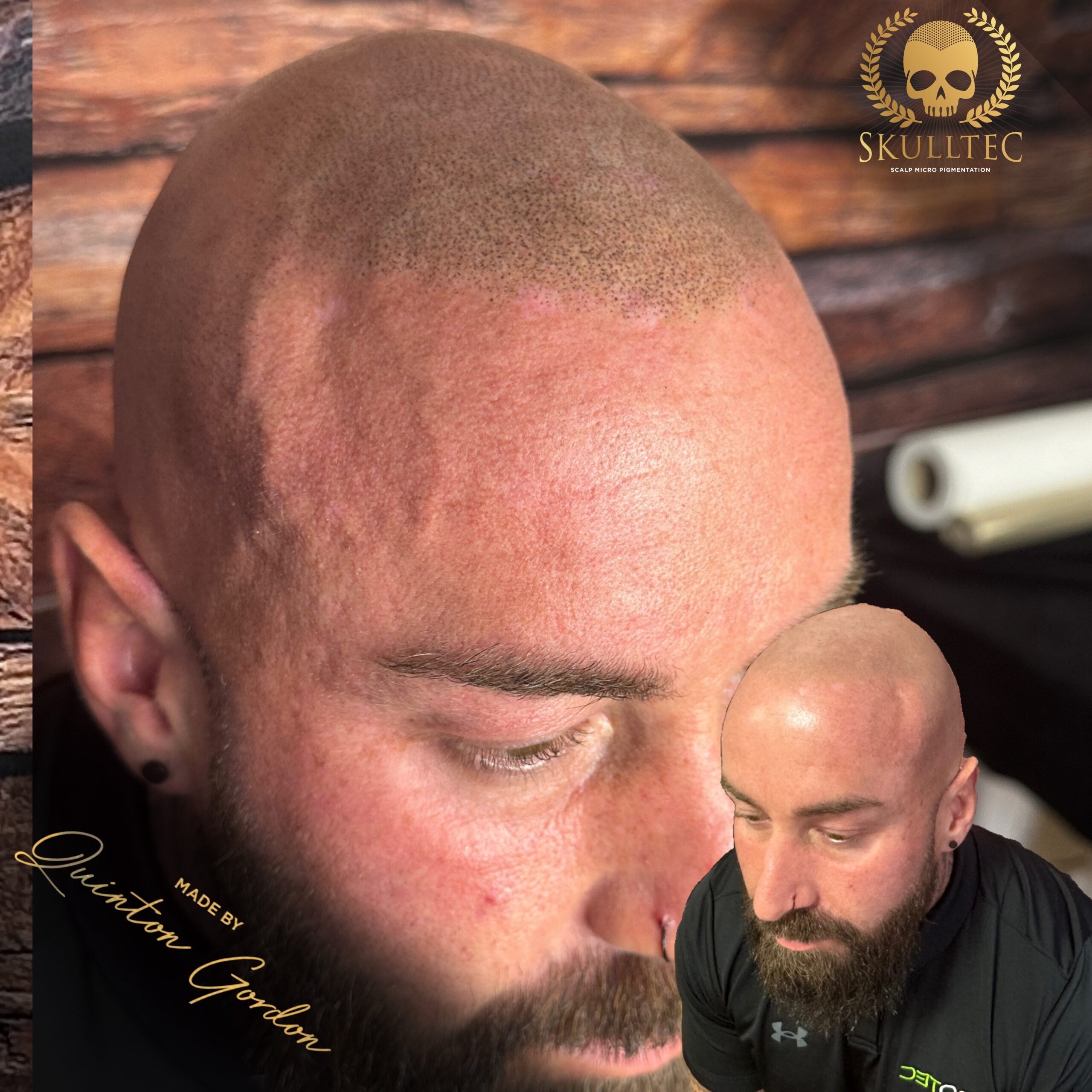Skulltec - Hairloss e8eb66f8 fe1d 4aa5 92f8 6e9482d95869